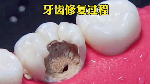 成人磨牙龋齿修复视频大全
